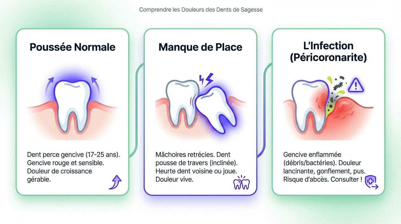 Schéma illustrant l'inflammation et la douleur lors de la poussée d'une dent de sagesse