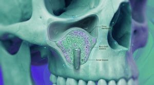 sinus lift and bone graft for dental implants 3